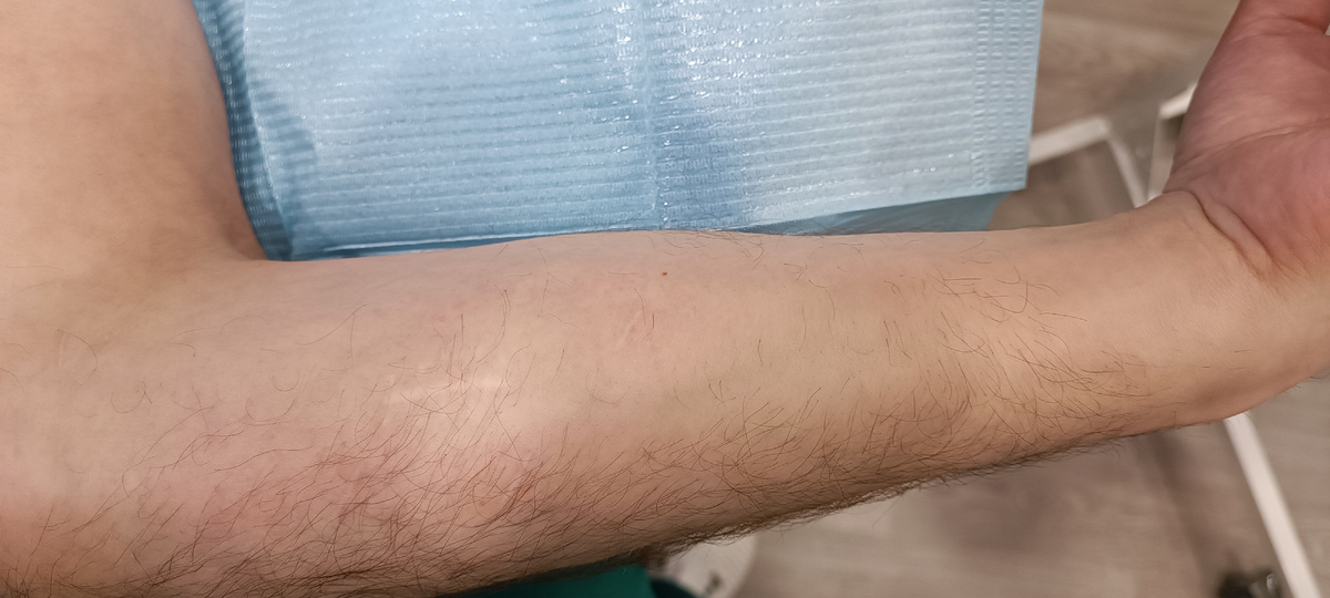 Эти же рубцы, вид без стрелок