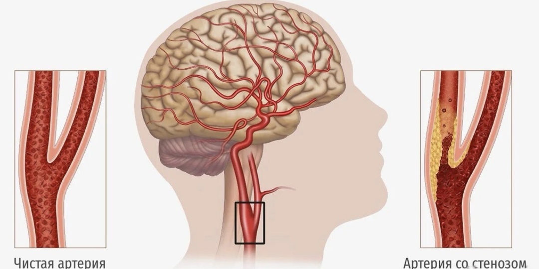 Инсульт в 37 лет? Атеросклероз сонных артерий: безмолвный убийца.