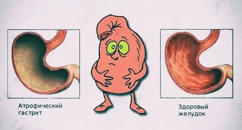 Гастрит : как распознать, остановить и жить без боли