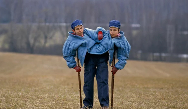 Две жизни в одном теле: история сестер Кривошляповых. "Юбилей хотели бы отметить на том свете..."