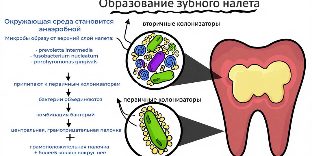 Что «убивает» импланты зубов после установки?