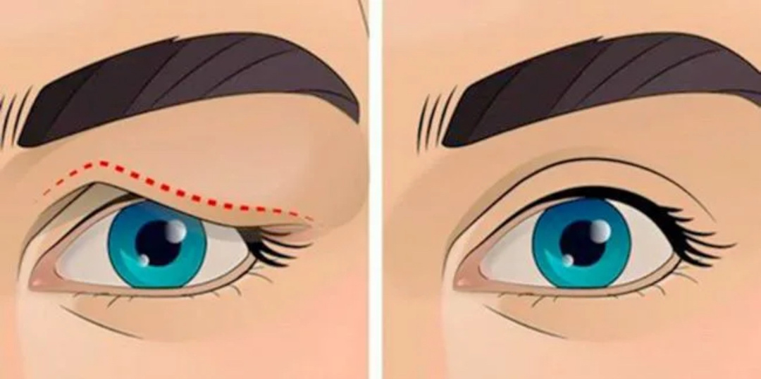 Без него уже не могу: когда нависшие веки надоели, а глаза надо открыть - полный комплекс для век