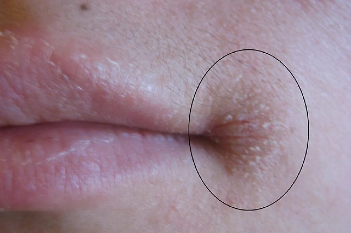    Врач Продеус: организму не хватает железа при заедах в уголках рта