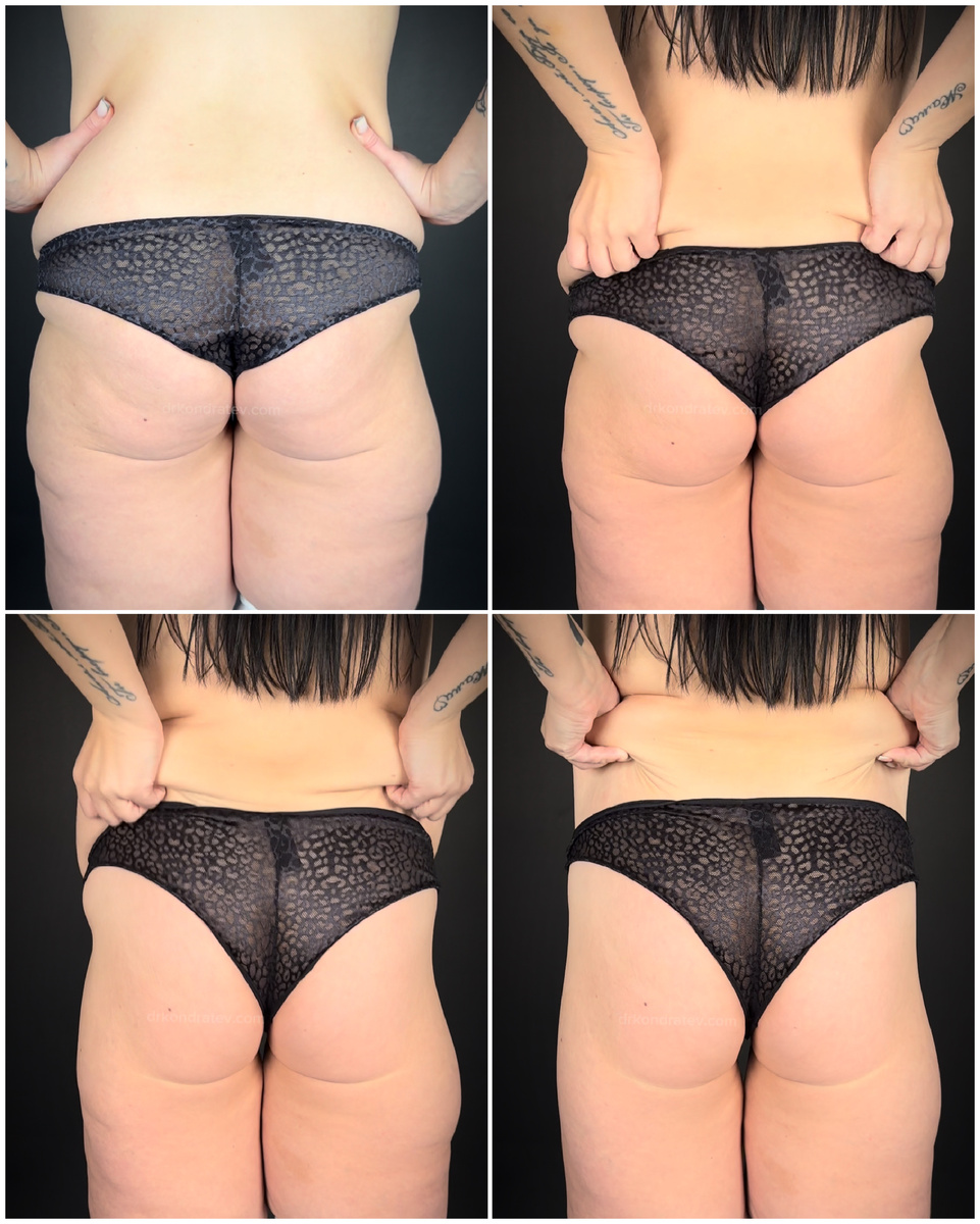 тянем кожу поясни вверх