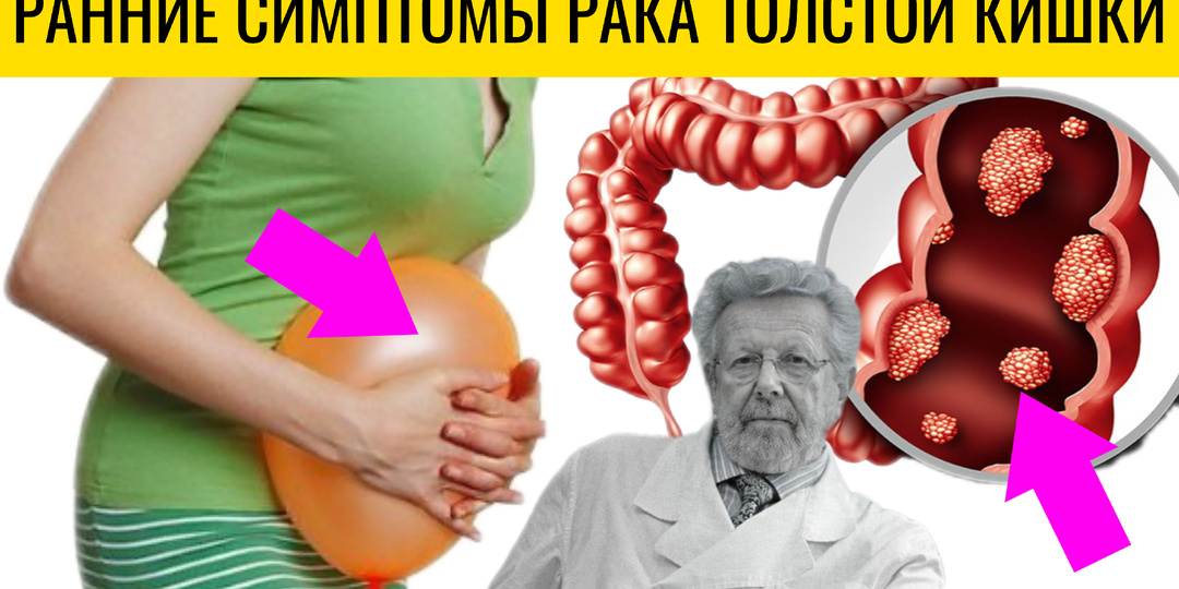 Не для самодиагностики, а для своевременного профессионального скрининга: 9 ранних симптомов рака толстой кишки по мнению врачей