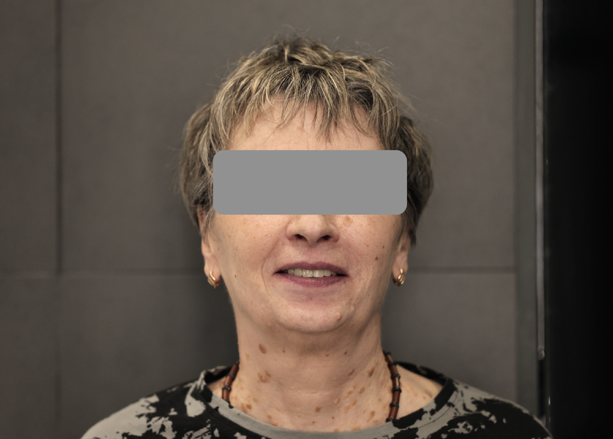 Сдача временного адаптационного протеза через 9 дней после операции