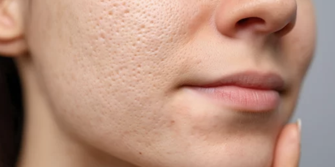 Рубцы на лице - приговор? Ответ врача с 20 летней практикой