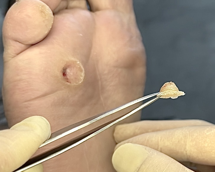 Сухая стержневая мозоль после полного ее извлечения 