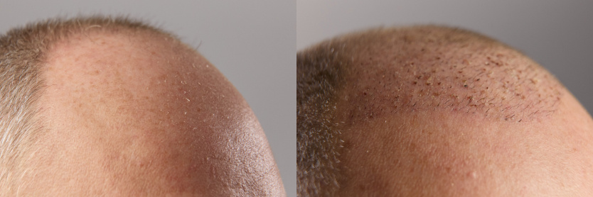 «Я больше не прятал залысины под кепкой». История Михаила из Красноярска