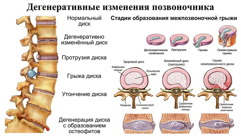 Дегенеративные заболевания позвоночника: