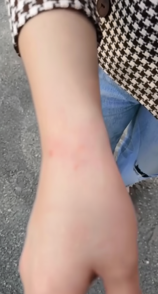 Фотография следов на запястье девушки