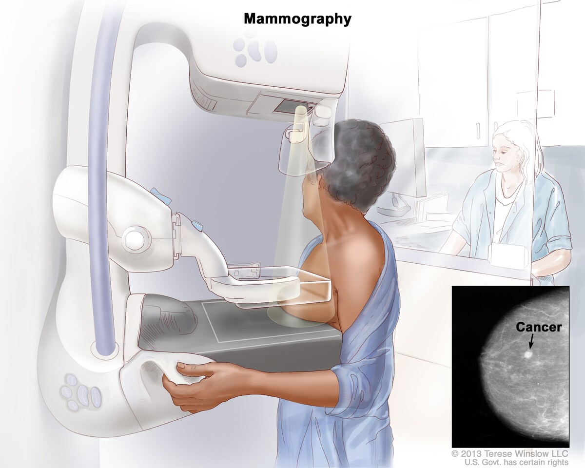 Источник картинки: https://www.cancer.gov/types/breast/patient/breast-screening-pdq