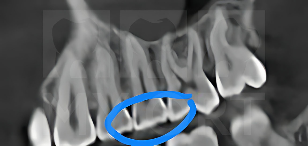 Скрытые кариозные полости на снимке КЛКТ