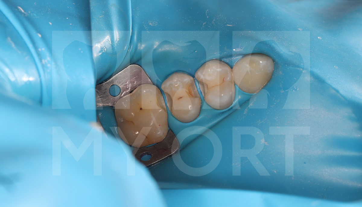 Зубы покрытые коффердамом и готовы к терапевтическому лечению