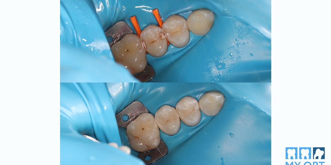 Скрытый кариес перед брекетами. Реальный кейс врача-стоматолога