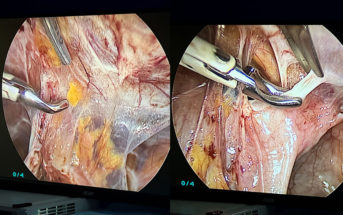 Спайки в брюшной полости.