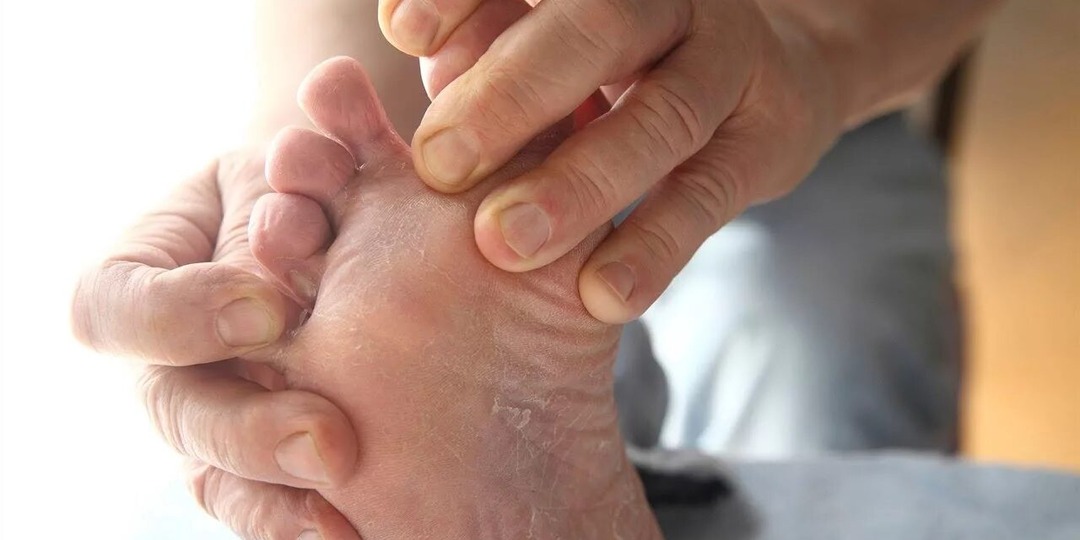 Поражение стоп и пятна на руках при диабете: почему появляются, как лечить и как предотвратить