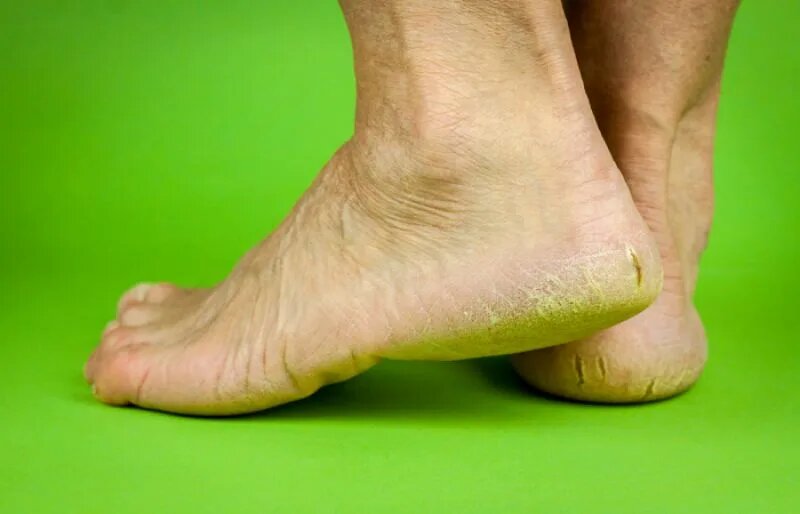 Кожа кричит о помощи: как диабет проявляется на коже — и что с этим делать