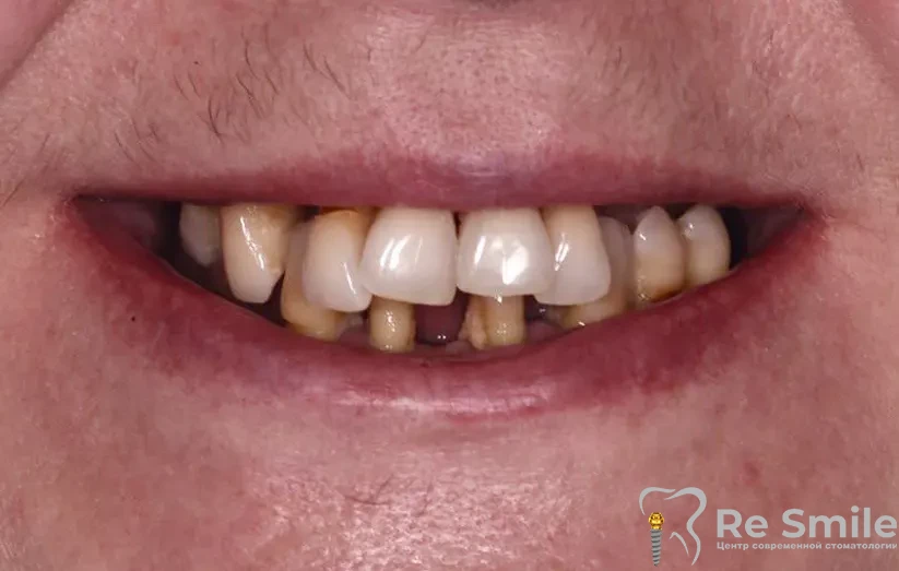 Пациентка Павлова Татьяна Андреевна обратилась в клинику ReSmile по поводу частичного отсутствия и подвижности зубов на верхней и нижней челюсти, эстетический дефект.