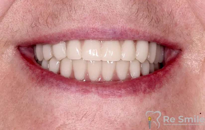 Пациентке были удалены все зубы. Установлены 8 одноэтапных имплантов на верхнюю и нижнюю челюсть. На четвертый день были зафиксированы временные адаптационные протезы.