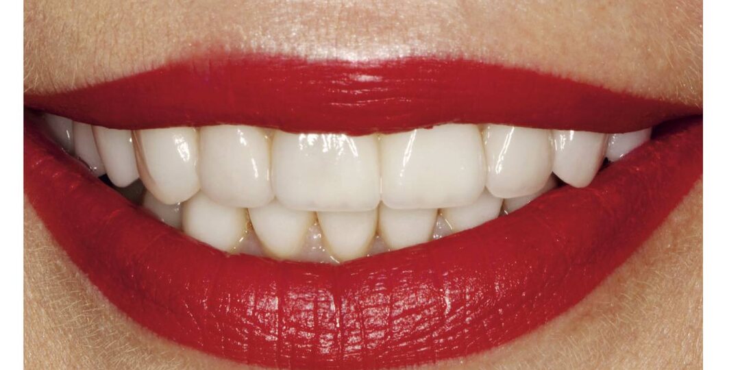 «Виниры, которые вечно отклеивались».