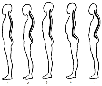 Рисунок. Формы осанки: 1 – нормальная осанка; 2 – круглая спина; 
3 – плоская спина; 4 – вогнуто-плоская спина; 5 – вогнуто-круглая спина.
