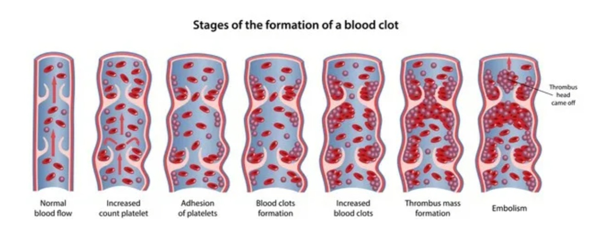 Процесс образования тромба в венах