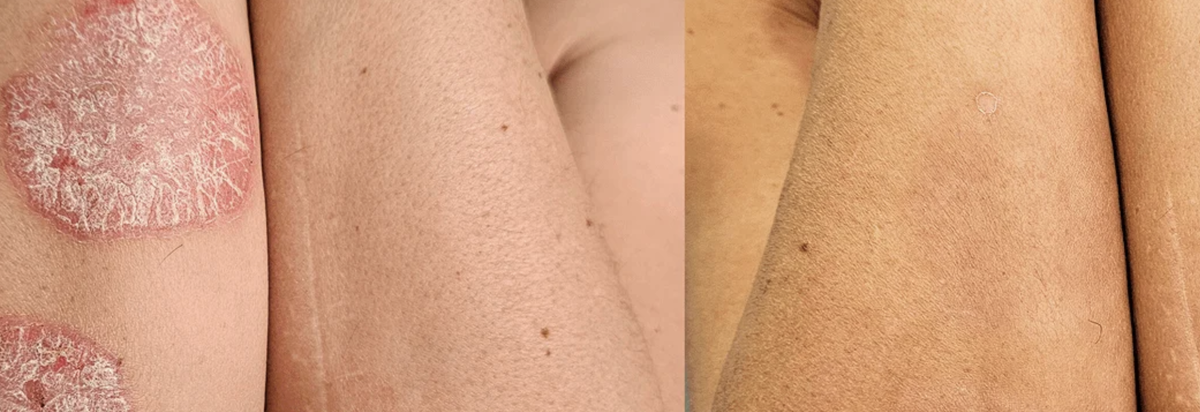 «Я 15 лет пряталась от людей. Носила длинные рукава в жару. Не ходила на пляж. А нужно было просто начать с кишечника».