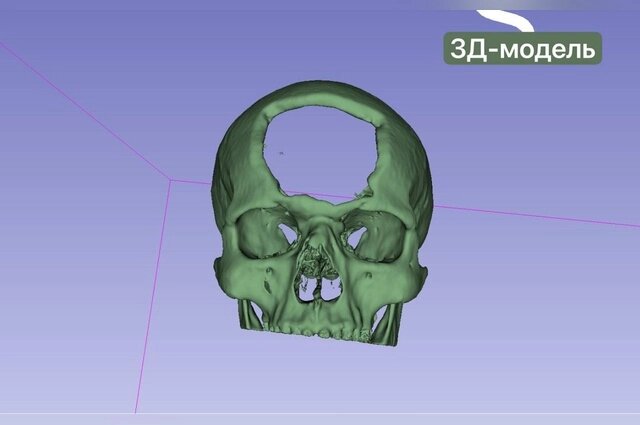    В результате ранения он получил серьезную травму головы. Фото: Telegram-канал РКБ Татарстан