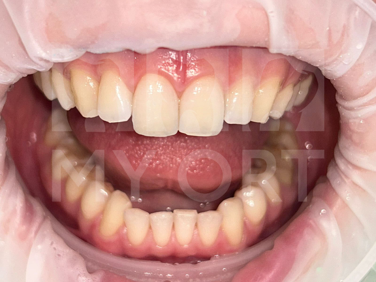 Зуб полностью восстановил анатомическую форму и эстетические свойства