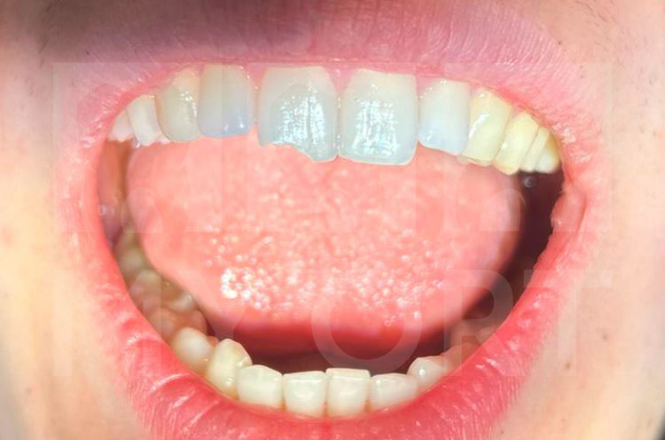 Горизонтальный перелом коронковой части зуба