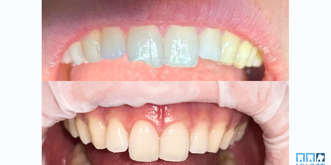 Зуб, сломанный разводным ключом: как мы восстановили его за 1 час. Реальный случай