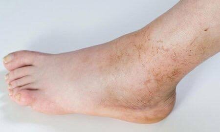 Красно-коричневые пятна на ногах