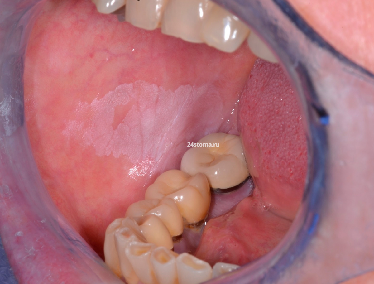 Плоская форма лейкоплакии. Фото с сайта 24stoma.ru