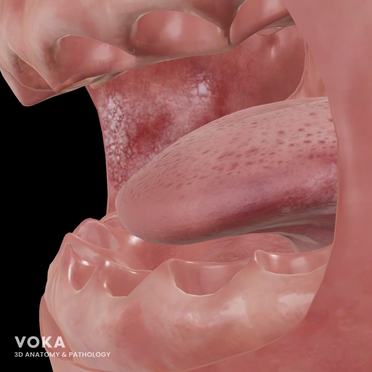 VOKA - лейкоплакия 