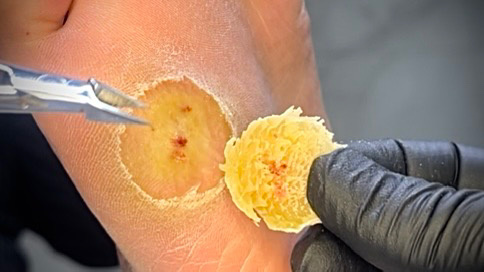 Слайс мозольной массы