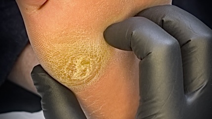 Внушительный размер мозольного ороговения