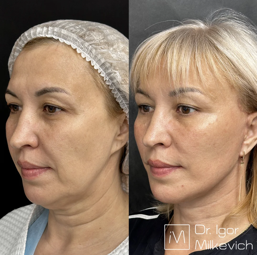 Месяц после хирургического смас-лифтинга