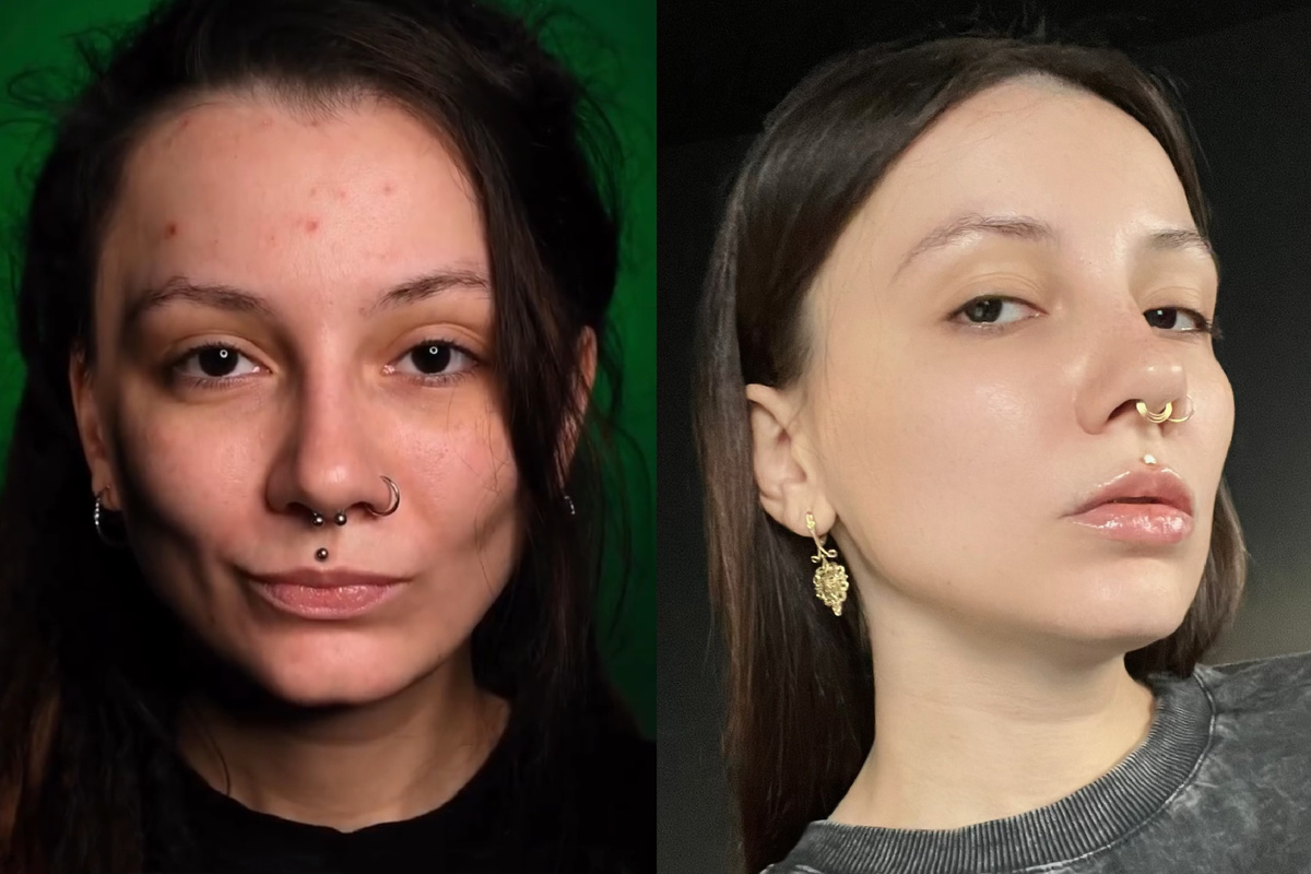 Это ещё не худшая фотография с того периода. В худшие времена я вообще не фотографировалась: прыщи были на лбу, подбородке, щеках, висках