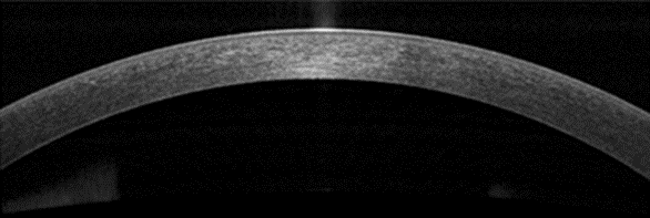 Рис. 1. Оптическая когерентная томография переднего сегмента глаза (AS-OCT) нормальной слёзной плёнки и роговицы.
AS-OCT-изображение демонстрирует нормальную структуру слёзной плёнки и роговицы.
