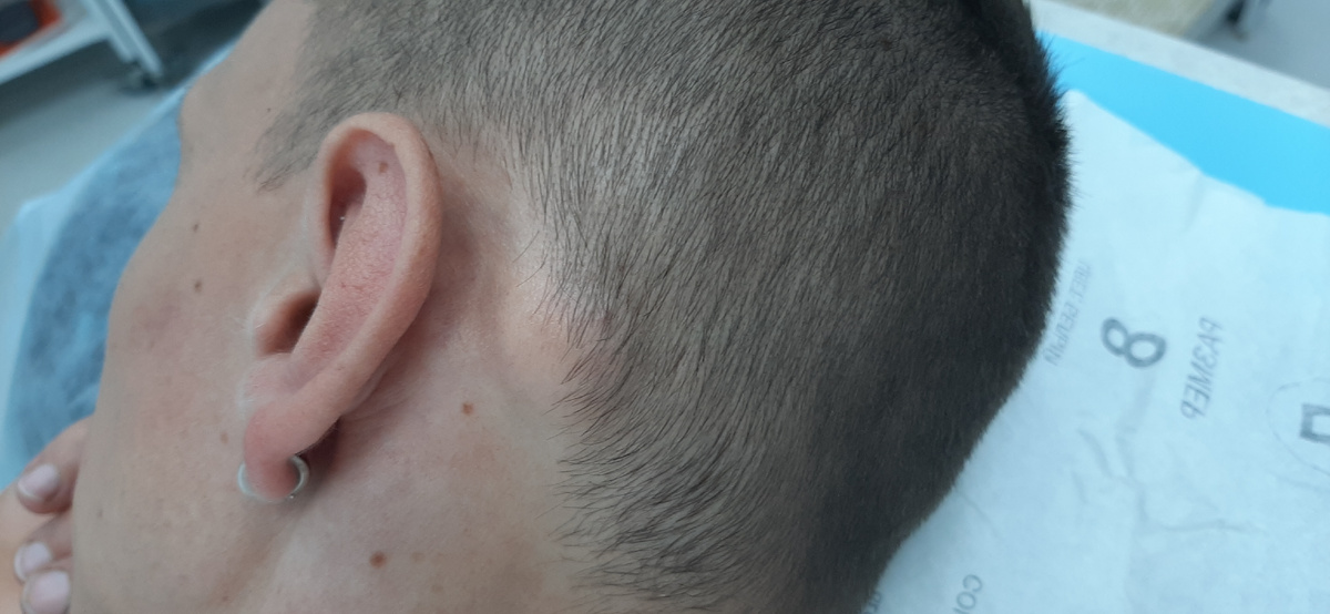 На представленном фото состояние перед операцией. Новообразование расположено в околоушной области слева и отчётливо видно.