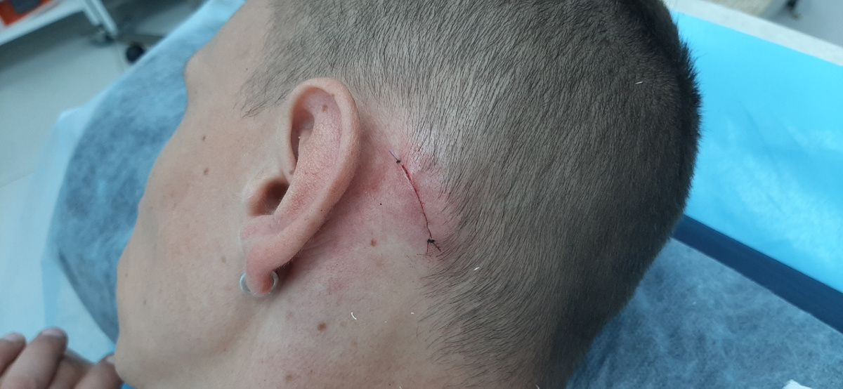 После операции. Видна линия соприкосновения краёв кожи и фиксирующие узлы.