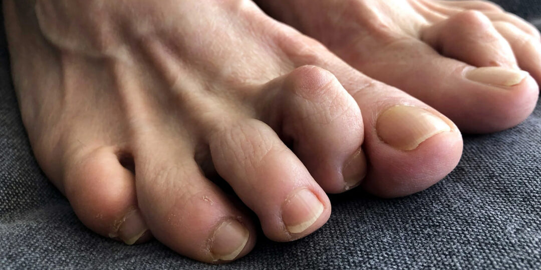 Пальцы «молоточком», натоптыши, вальгус… Что означают деформации стопы и как их скорректировать?