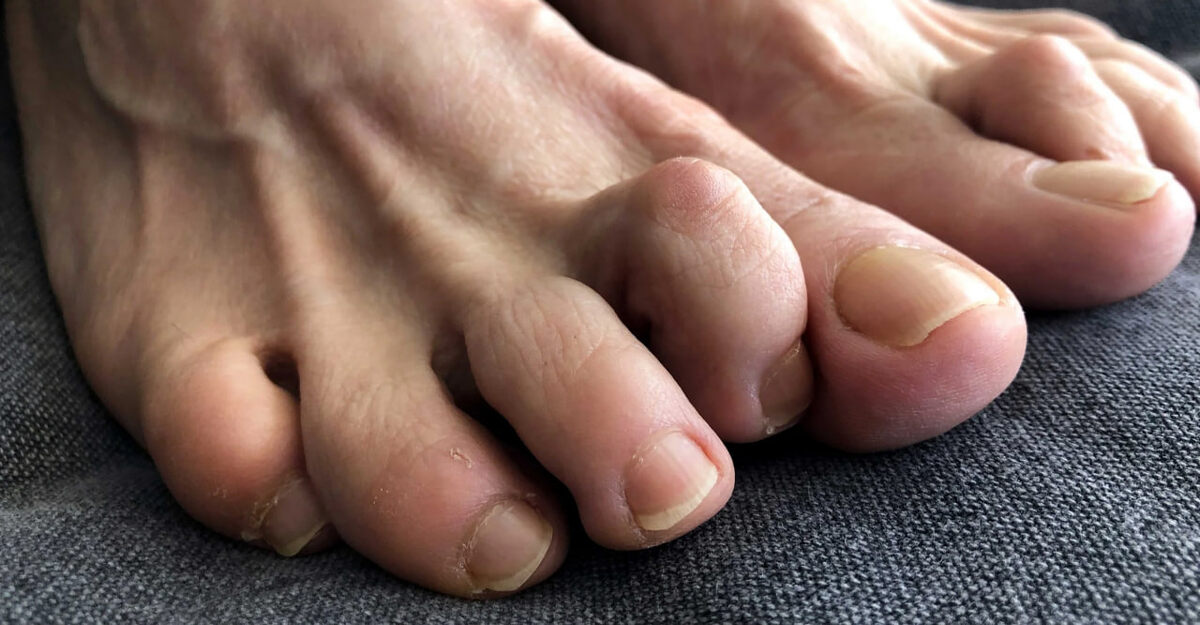 Пальцы «молоточком»