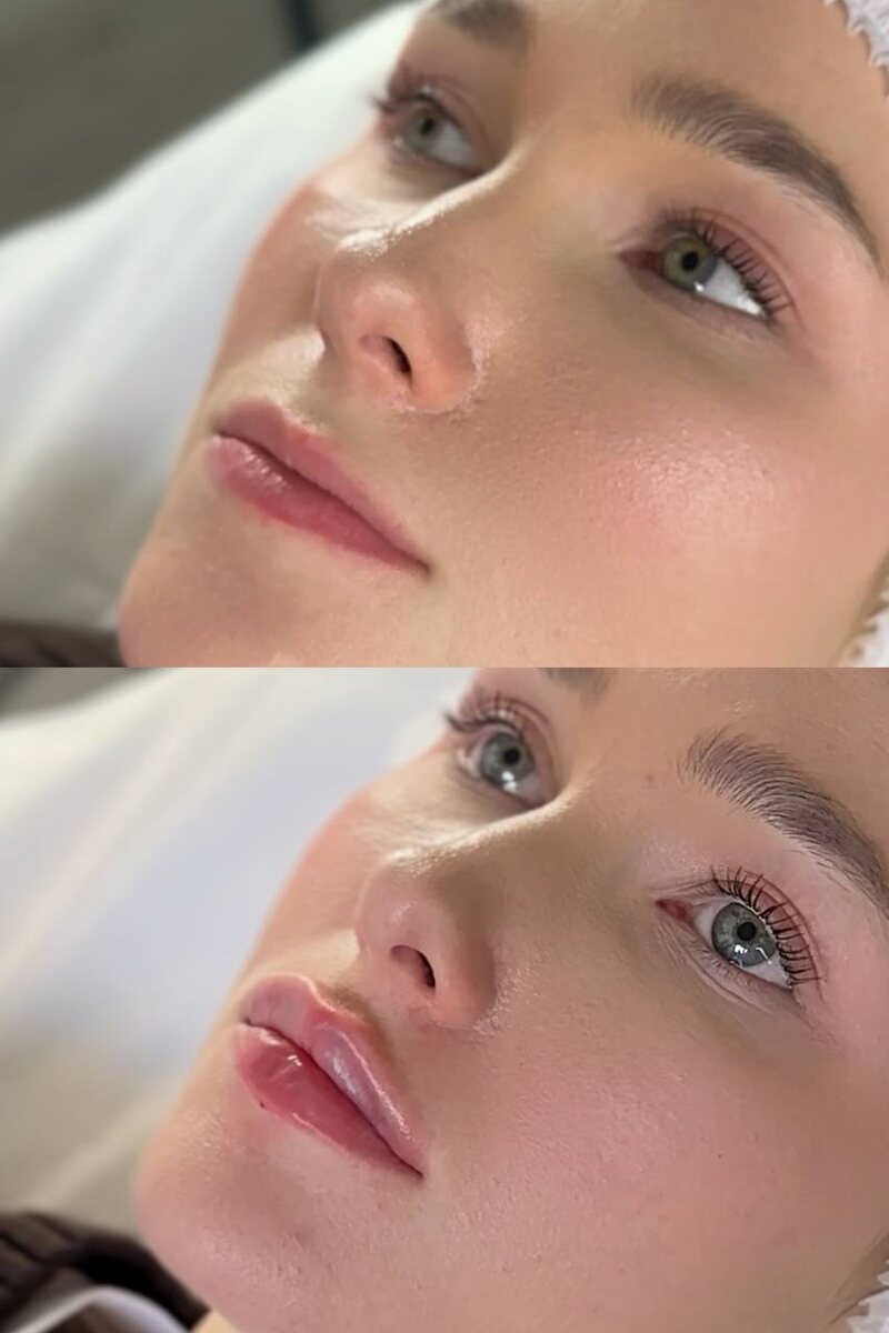 до/сразу после процедуры