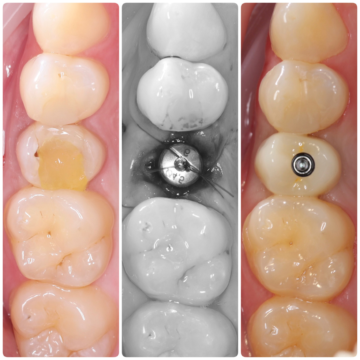Одномоментная имплантация в области 2.5 зуба и постоянная коронка. До / после операции / после фиксации постоянной коронки (через 3 месяца)