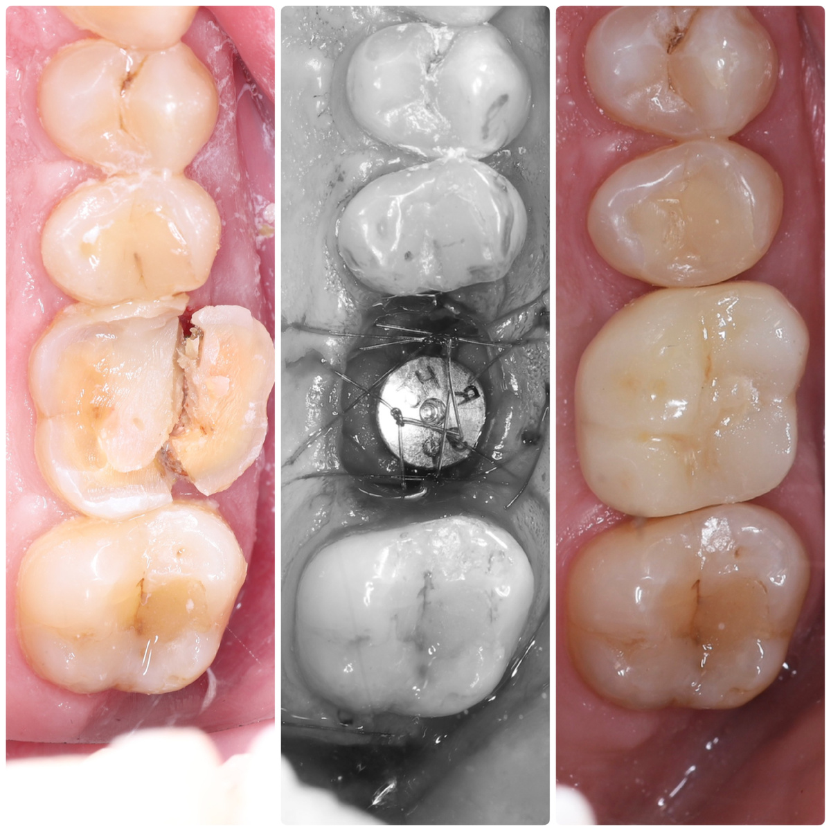 Одномоментная имплантация в области 1.6 зуба. До / после операции / после фиксации постоянной коронки (через 3 месяца)  