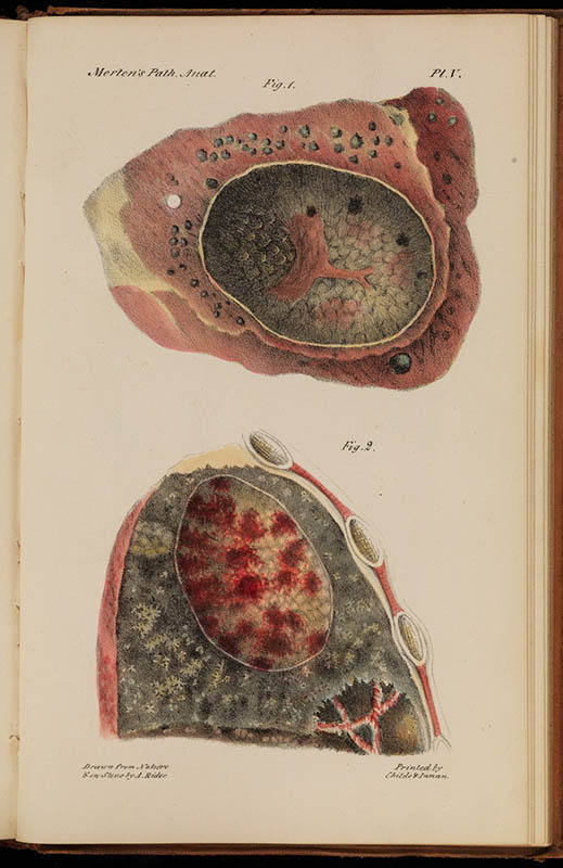 Легкие молодого человека, умершего от туберкулеза , фото V, 1834 г., из коллекции Уэллкома