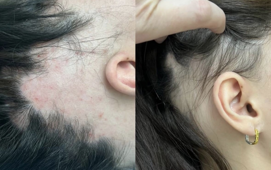 Когда волосы начинают предавать - это боль, которую трудно скрыть. Но даже после сильного стресса рост можно вернуть. Рассказываю, как я лечу выпадение волос и помгаю восстановить их здоровье и густоту.