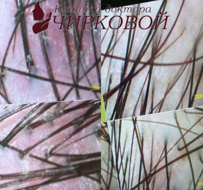 Дерматоскопия. Серборейный дерматит кожи головы.